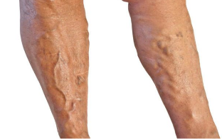 Tratamento de varices nas pernas