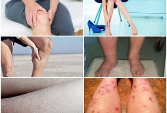 Síntomas de varices nas pernas