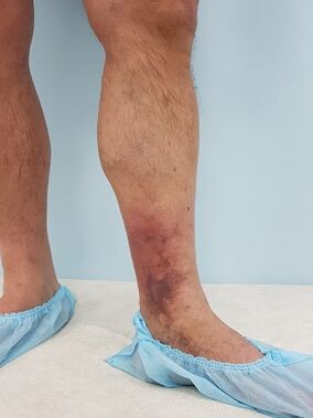 complicacións das varices nos homes