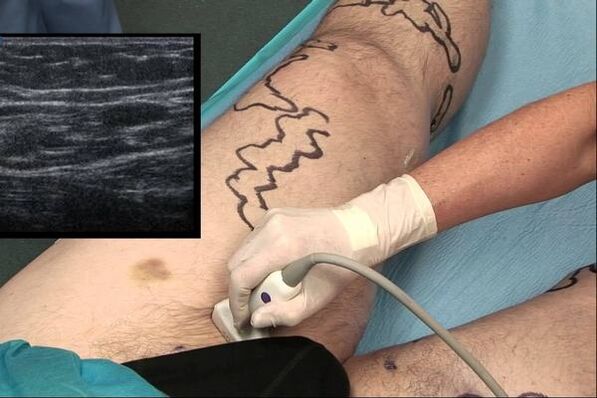diagnóstico de varices en homes