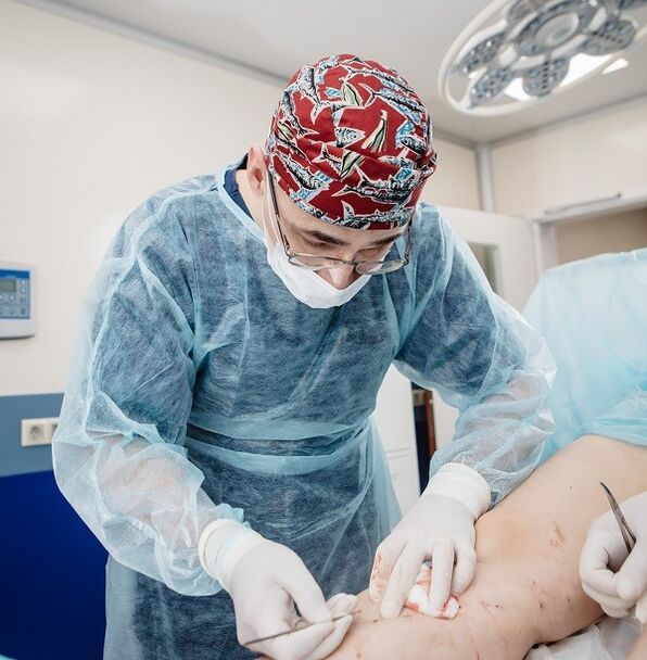 tratamento cirúrxico das varices