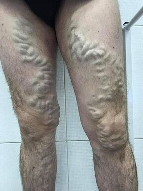 varices masculinas descoidadas