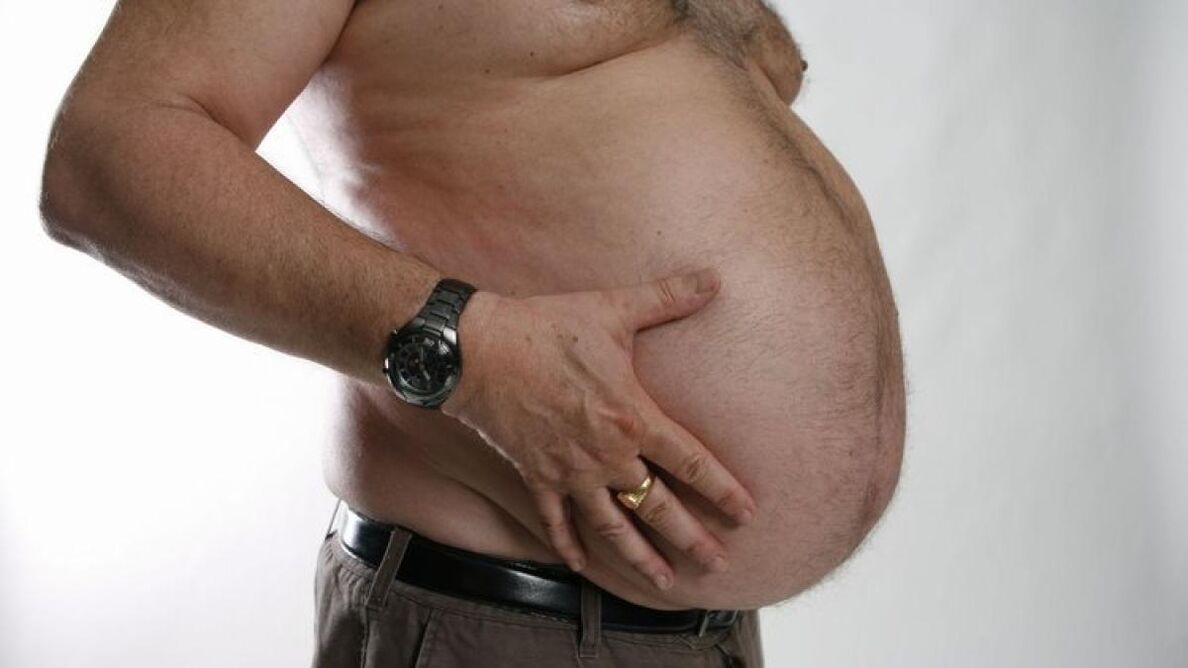 obesidade como causa do desenvolvemento de varices
