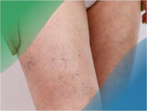 A rede vascular nas pernas é un dos síntomas das varices