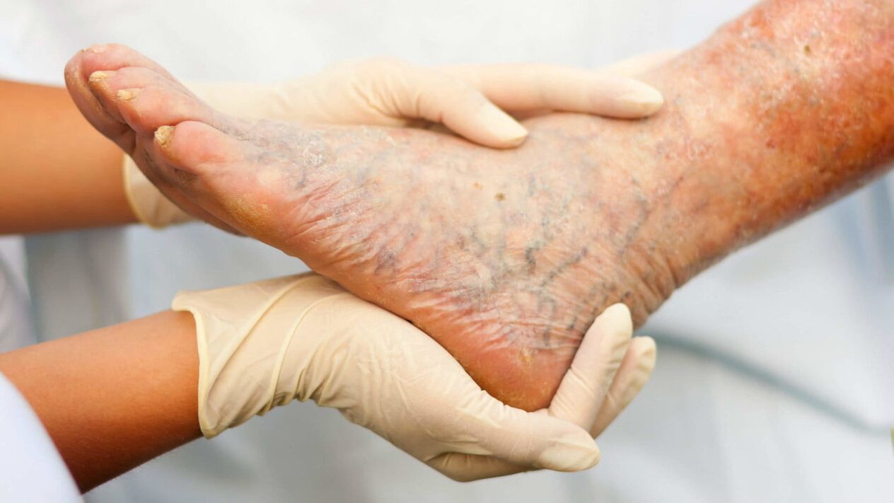 O flebólogo trata o tratamento das varices nas pernas