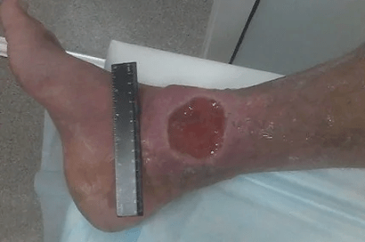 Complicacións de varices