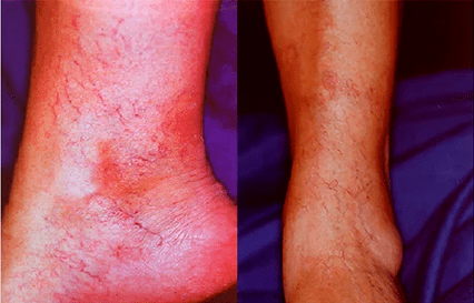 Varices