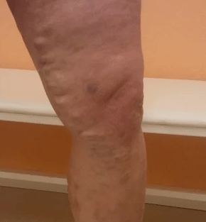 varices