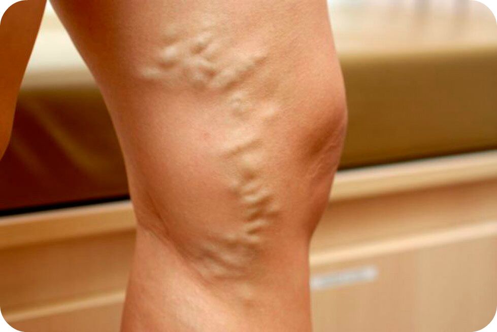 Varices das veas