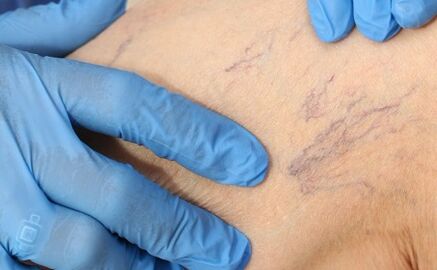 Síntomas de varices