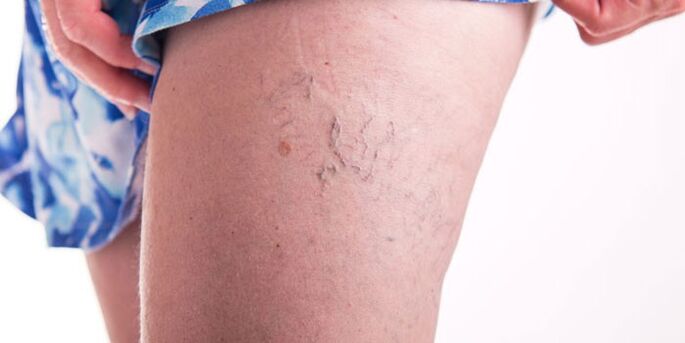 Prevención de varices