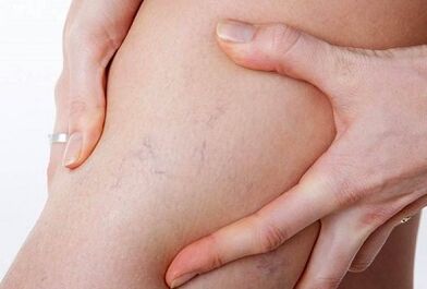 Accións prohibidas para varices