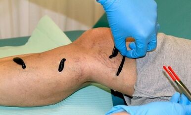 Hirudoterapia para varices