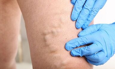 Varices nas pernas
