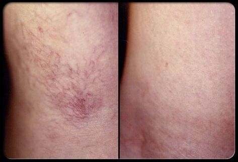 Antes e despois da escleroterapia