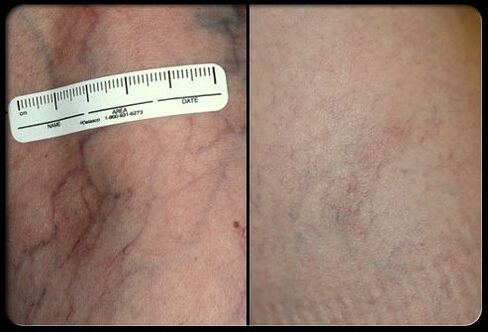 Antes e despois do procedemento de terapia con láser