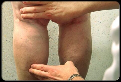 O médico examina as pernas con varices