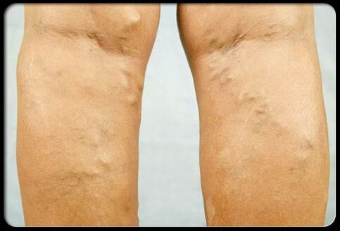 Varices nas pernas