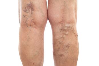 varices das extremidades inferiores